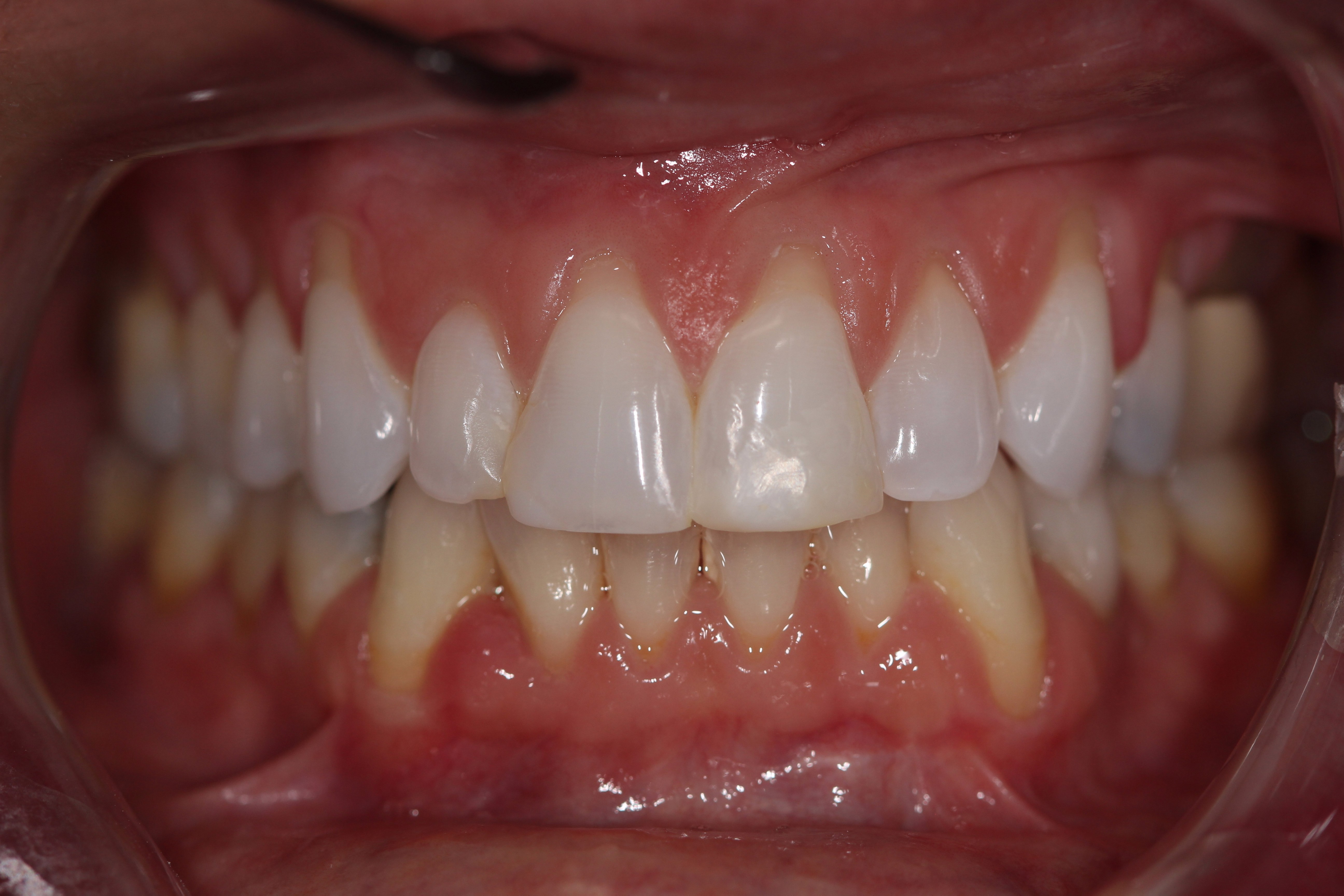 Before and after photo - Connor Family Dentistry in Hendersonville