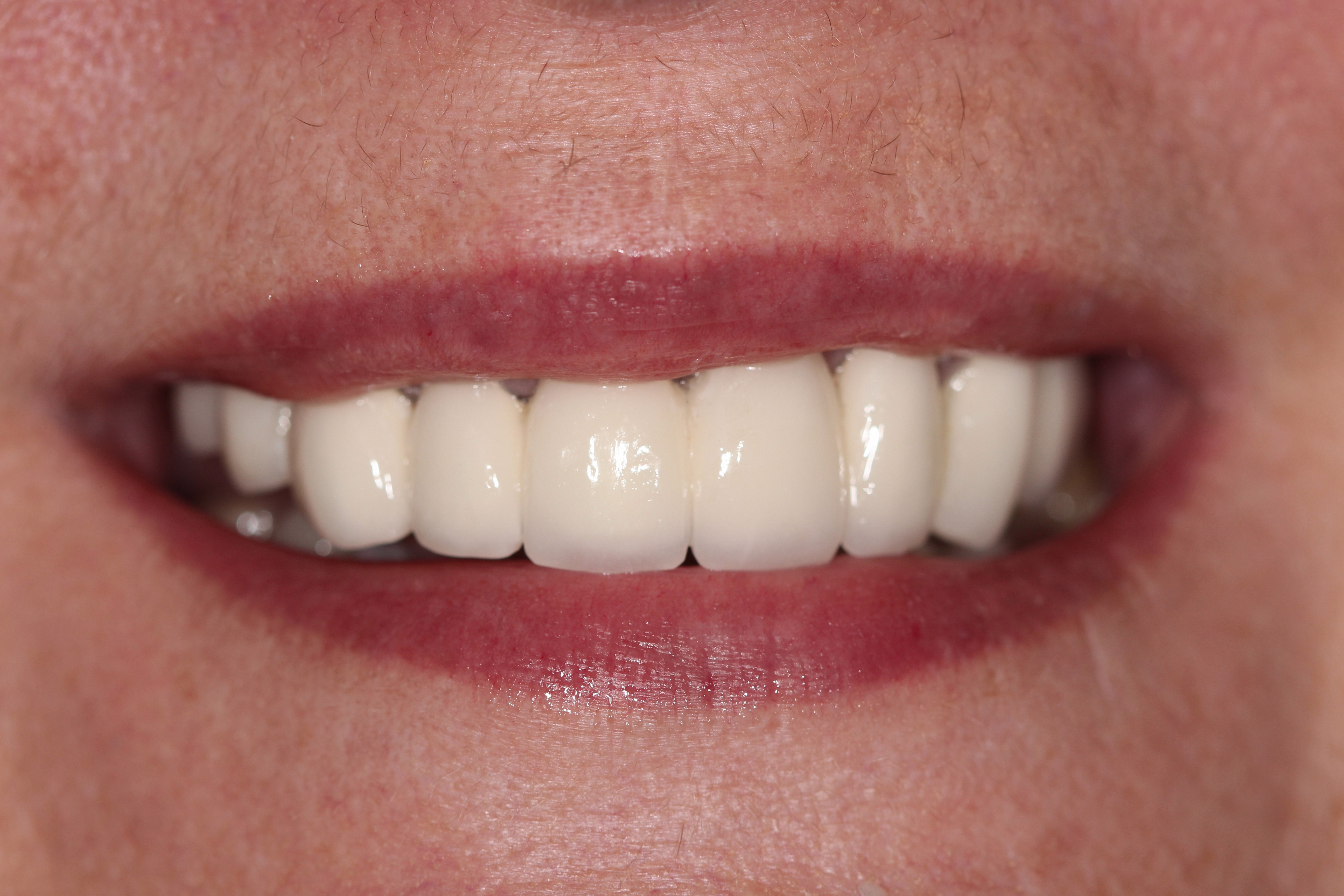 Before and after photo - Connor Family Dentistry in Hendersonville